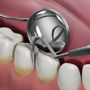 イメージ:予防歯科