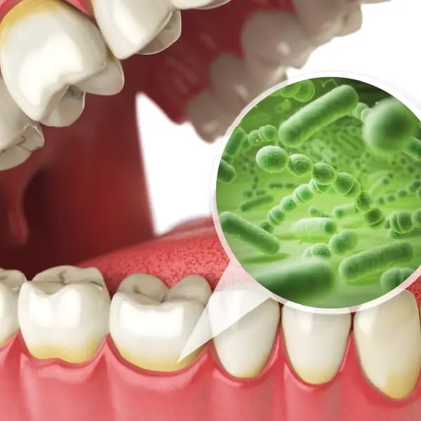 イメージ:歯周病治療