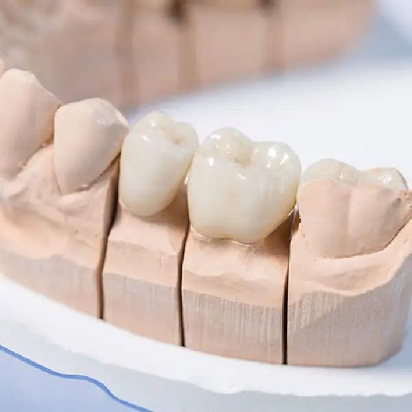 イメージ:つめ物・かぶせ物