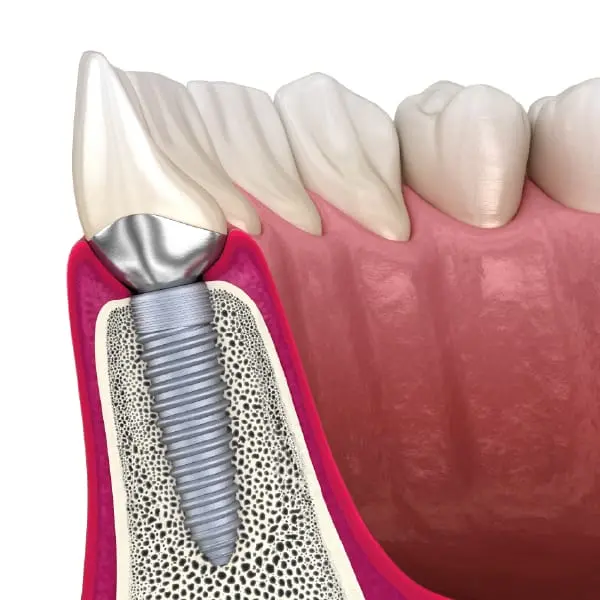 イメージ:インプラント